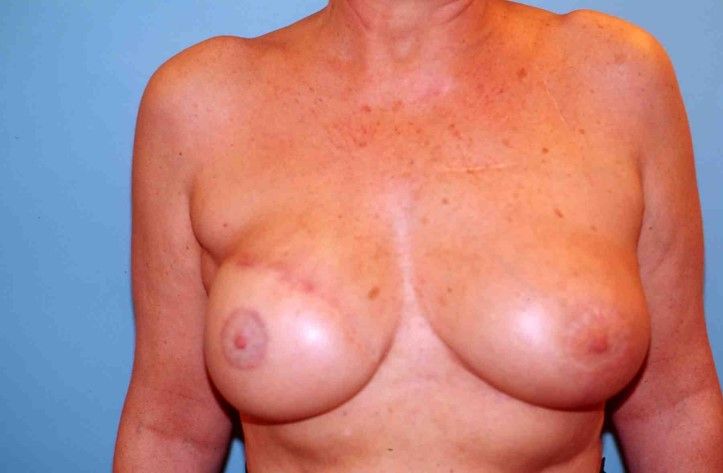 Pourquoi le Lambeau de Grand Dorsal : dans le hamac inférieur du sein, image 2 sur 2