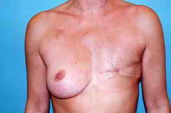 Photos avant après – la reconstruction différée : avec la peau saine du grand dorsal, image 1 sur 2