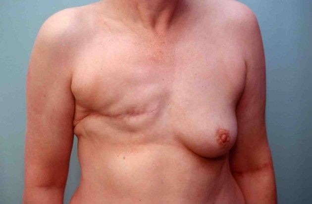 Photos avant après – la reconstruction différée : lipofeelings et lambeau de grand dorsal, image 1 sur 2