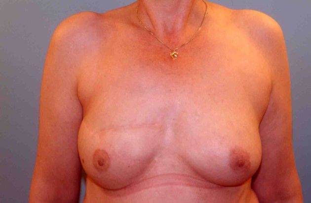 Photos avant après – la reconstruction différée : lipofeelings et lambeau de grand dorsal, image 2 sur 2