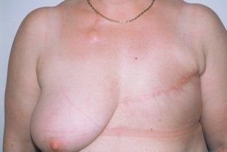 Photos avant après – la reconstruction différée : par grand dorsal + une prothèse sous le pectoral, image 1 sur 4