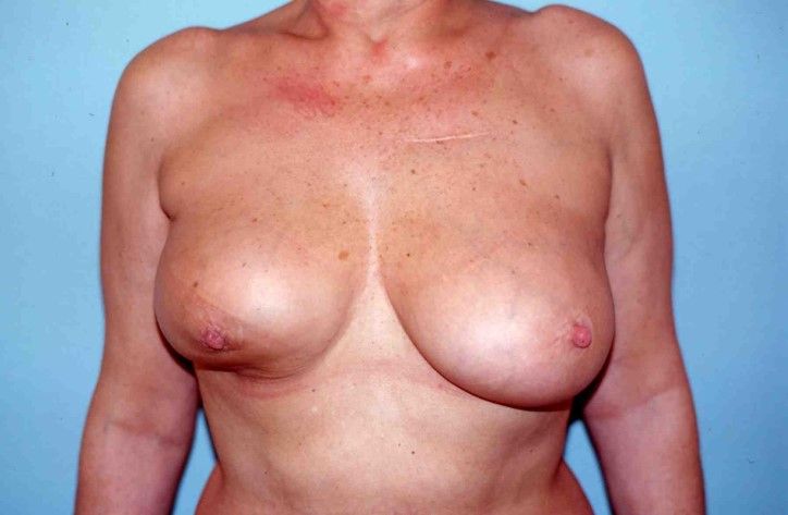 Pourquoi le Lambeau de Grand Dorsal : dans le hamac inférieur du sein, image 1 sur 2