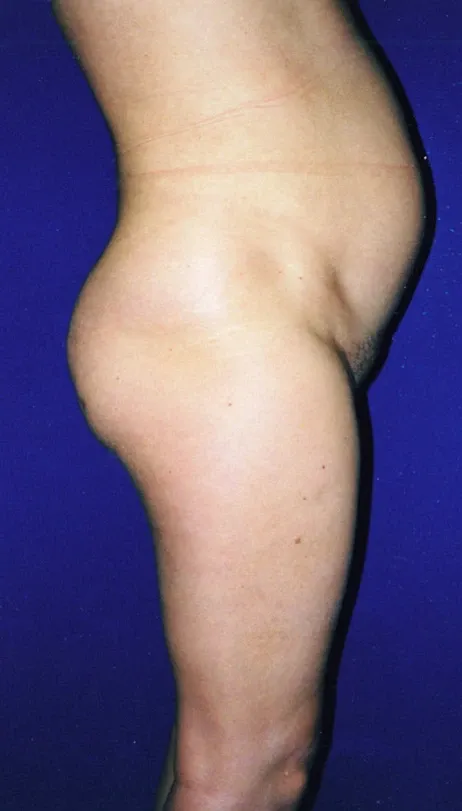 chirurgie esthétique ventre lipoaspiration à Paris