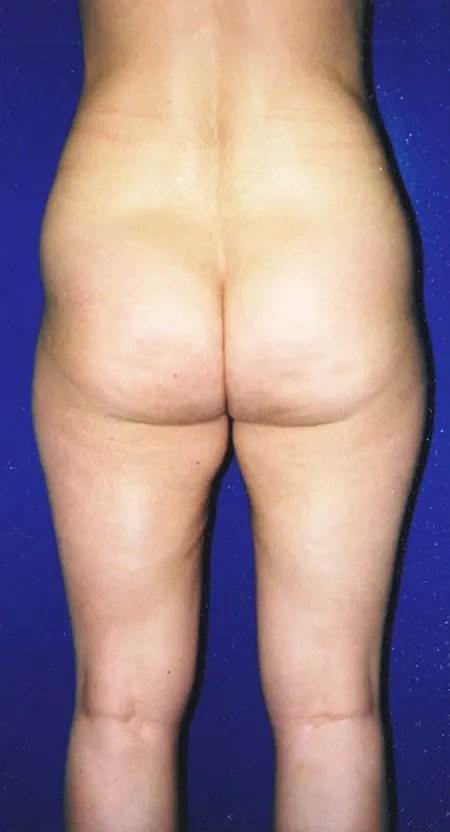 chirurgie esthétique ventre