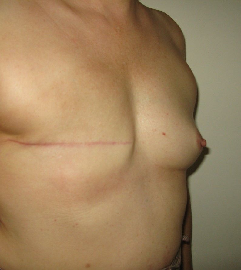 reconstruction par lambeau de grand dorsal
